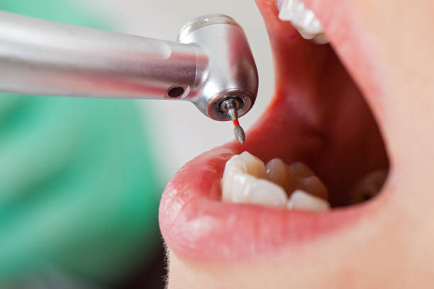 Best Emergency Root Canal Treatment in Pato, WA
